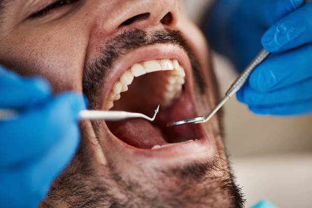 Best Emergency Dentist for Lost Fillings or Crowns in Pinole, CA